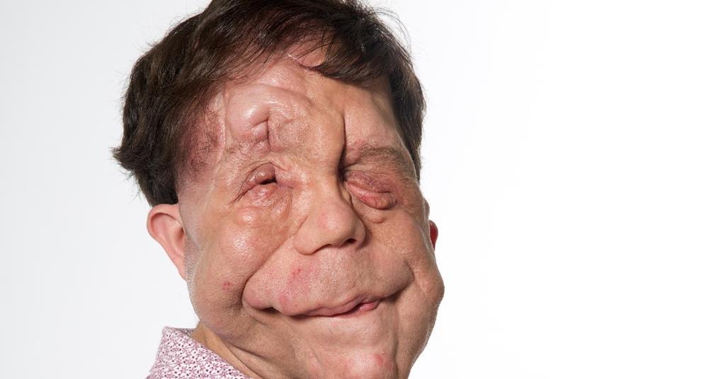 End Credits Adam Pearson Features Broadcast